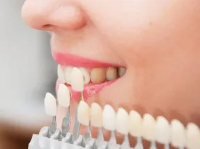 کامپوزیت دندان بهتر است یا لمینت سرامیکی؟