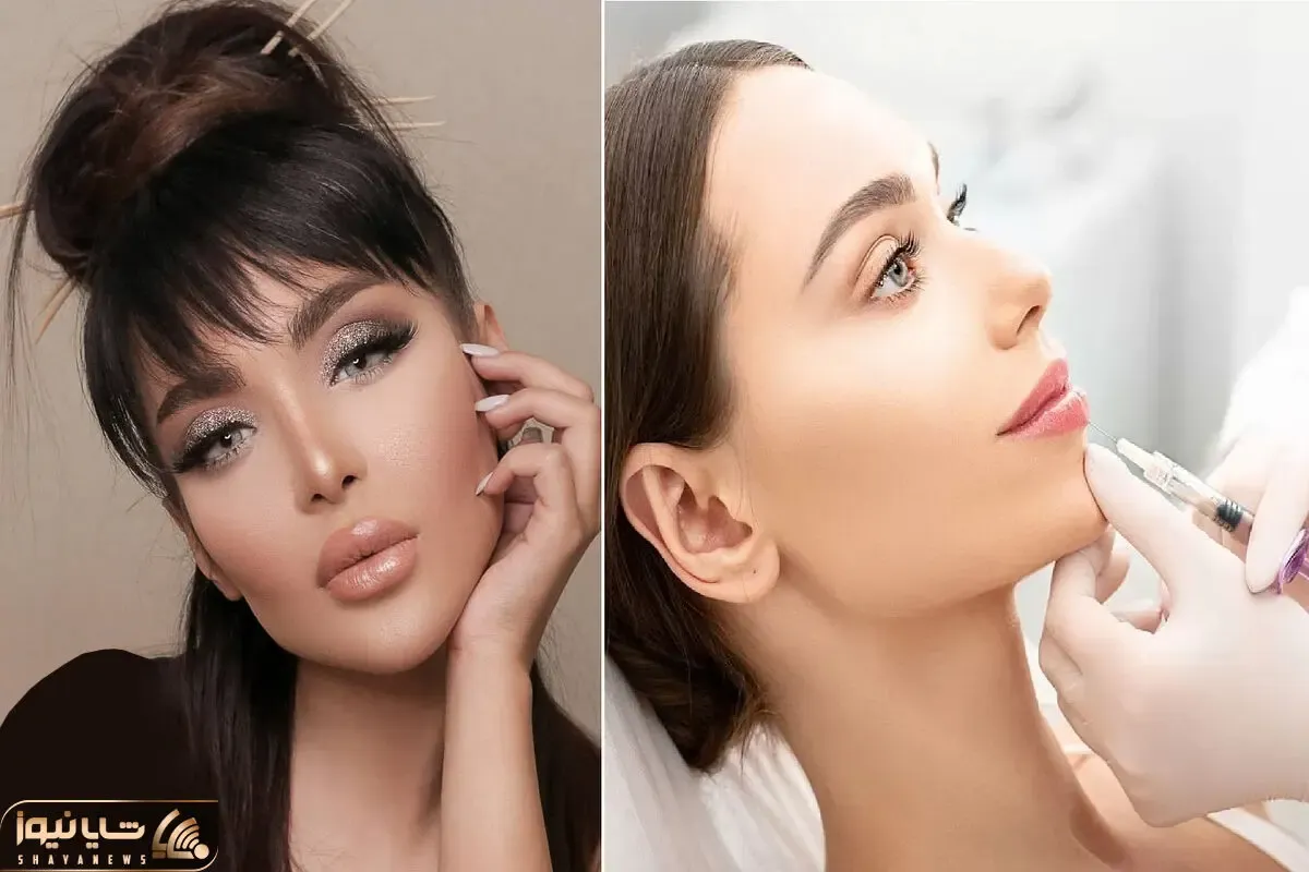 تفاوت ژل لب با فیلر در چیست؟ برای داشتن چهره ای جذاب آگاهانه تصمیم بگیرید!