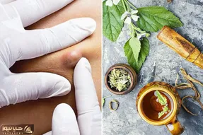 از بین بردن جوش های ران پا با ترفند راحت؛ با یکم از این روغن پاهاتو صاف صاف کن