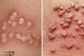 بهترین پزشکهای تهران برای درمان زگیل تناسلی؛ تفاوت و تشخیص جوش، تبخال و HPV