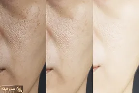 بهترین کرم ها برای بستن منافذ باز پوست و روشن کننده / چی خوبه، چی واقعاً جواب میده؟