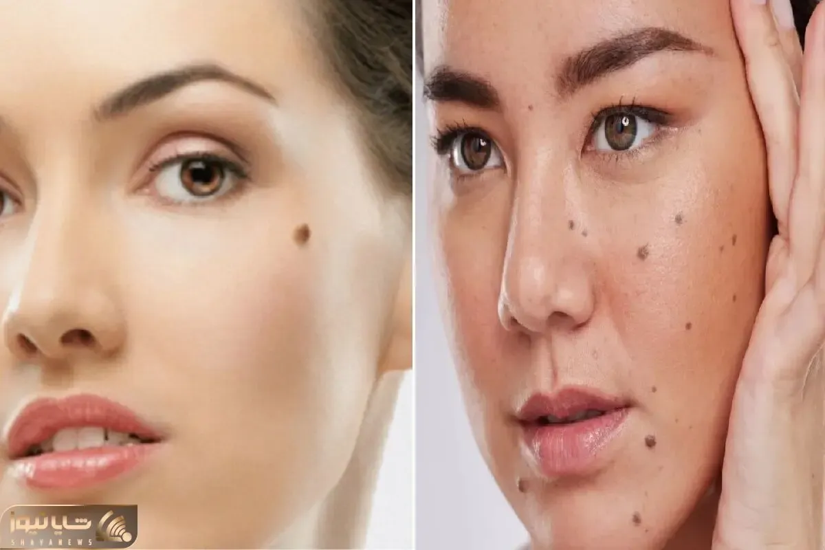 از بین بردن خال های صورت و بدن تنها در یک هفته؛ لیزر نکن پولتم هدر نده فقط با پیاز