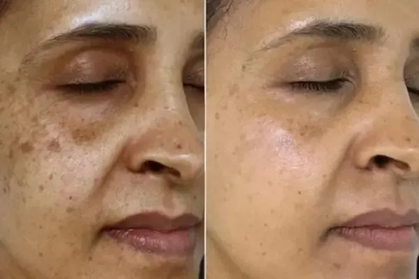 برای داشتن پوستی صاف، شفاف و بدون لک چه کنیم؟