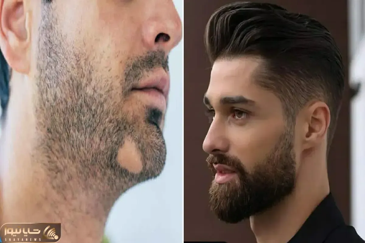 افزایش ریش مردان و از بین بردن طاسی اون؛ به ریش نیس به ریشه اس ولی برا گرو ریش میخوای