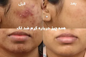 هر آنچه باید درباره کرم ضد لک بدانید