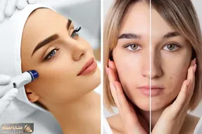میکرودرم واقعا صورت رو جوان میکنه یا نه؟ عوارض، مراقبت ها و پوست هایی که لازمشونه