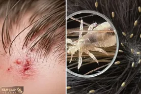 تشخیص رشک و شپش سر؛ از بین بردن شپش مو در خانه، نحوه مکیدن خون سر و سوالات رایج