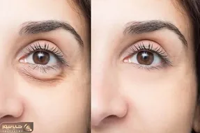 بهترین کرم دور چشم ایرانی برای رفع سیاهی و گودی؛ با کمترین خرج بهترین نتیجه رو بگیر