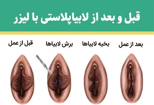 لابیا