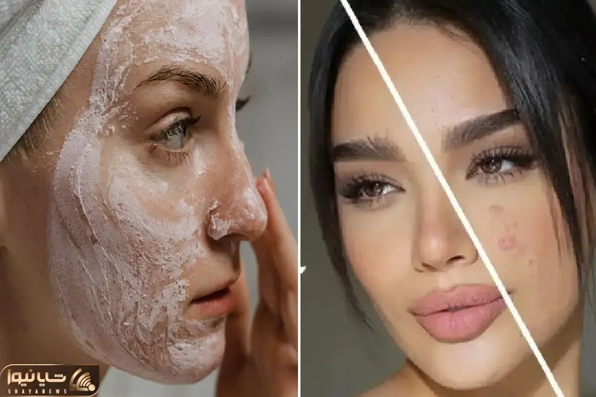 از بین بردن جوش های صورت در کمترین زمان تا عید / با کف دست جوش شیرین پوستتو آینه کن