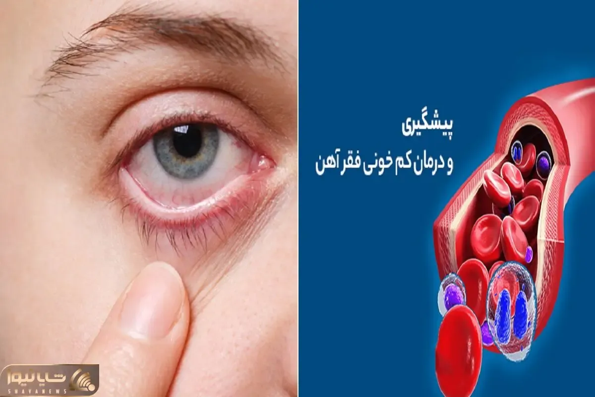 اگر این 5 نشانه رو دارید به احتمال قوی فقر آهن دارید| علامت خطری که اکثر ایرانیا دارن