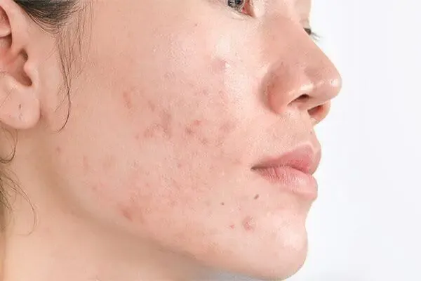 چگونه از شر لکه های سیاه روی پوست خلاص شویم