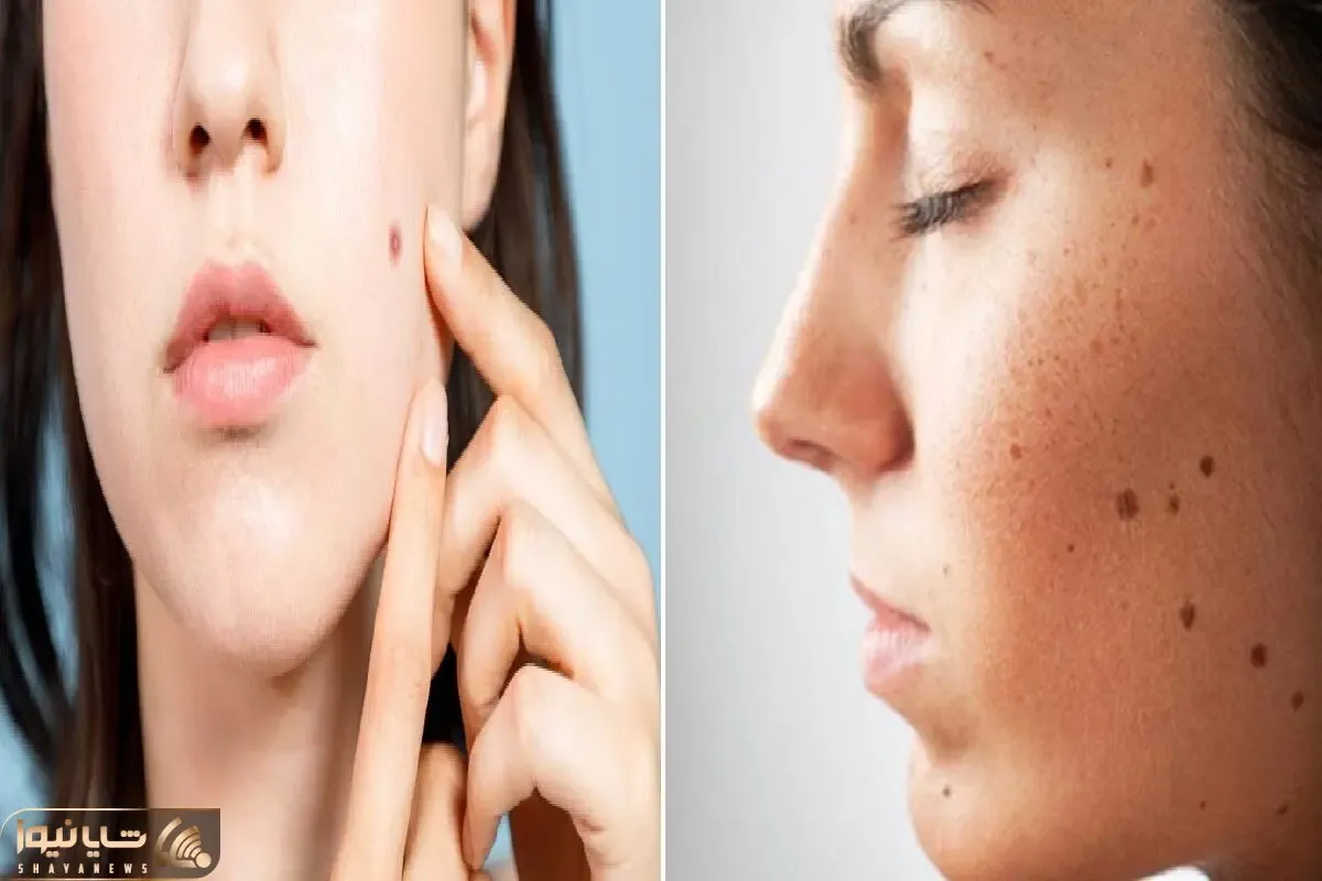 از بین بردن خال های صورت و بدن در خانه و با استفاه از مواد طبیعی؛ با سرکه سیب حلش کن