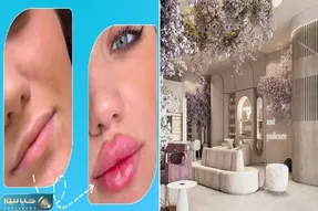 بهترین کلینیک تهران برای تزریق ژل/ حتی اگه لبات خیلی کوچیکن اینجا لب روسی میسازن برات
