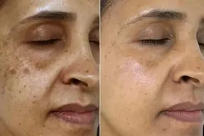 برای داشتن پوستی صاف، شفاف و بدون لک چه کنیم؟