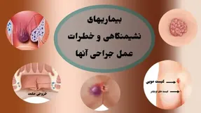 عمل جراحی بیماریهای نشیمنگاهی چه خطراتی دارد؟