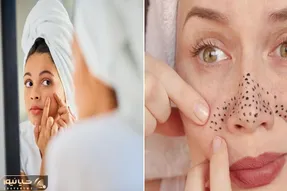 از بین بردن جوش سر سیاه بینی / به جای این که با ناخن بیفتی به جون دماغت خاک بزن روش