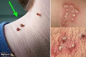 زگیل تناسلی چه شکلیه؟ گوشت اضافه چه شکلی؟ (درمان)