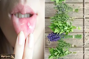 از بین بردن آفت دهان با روش های طبیعی؛ دوبار این کار رو کن فرداش یادت نمیاد آفت داشتی