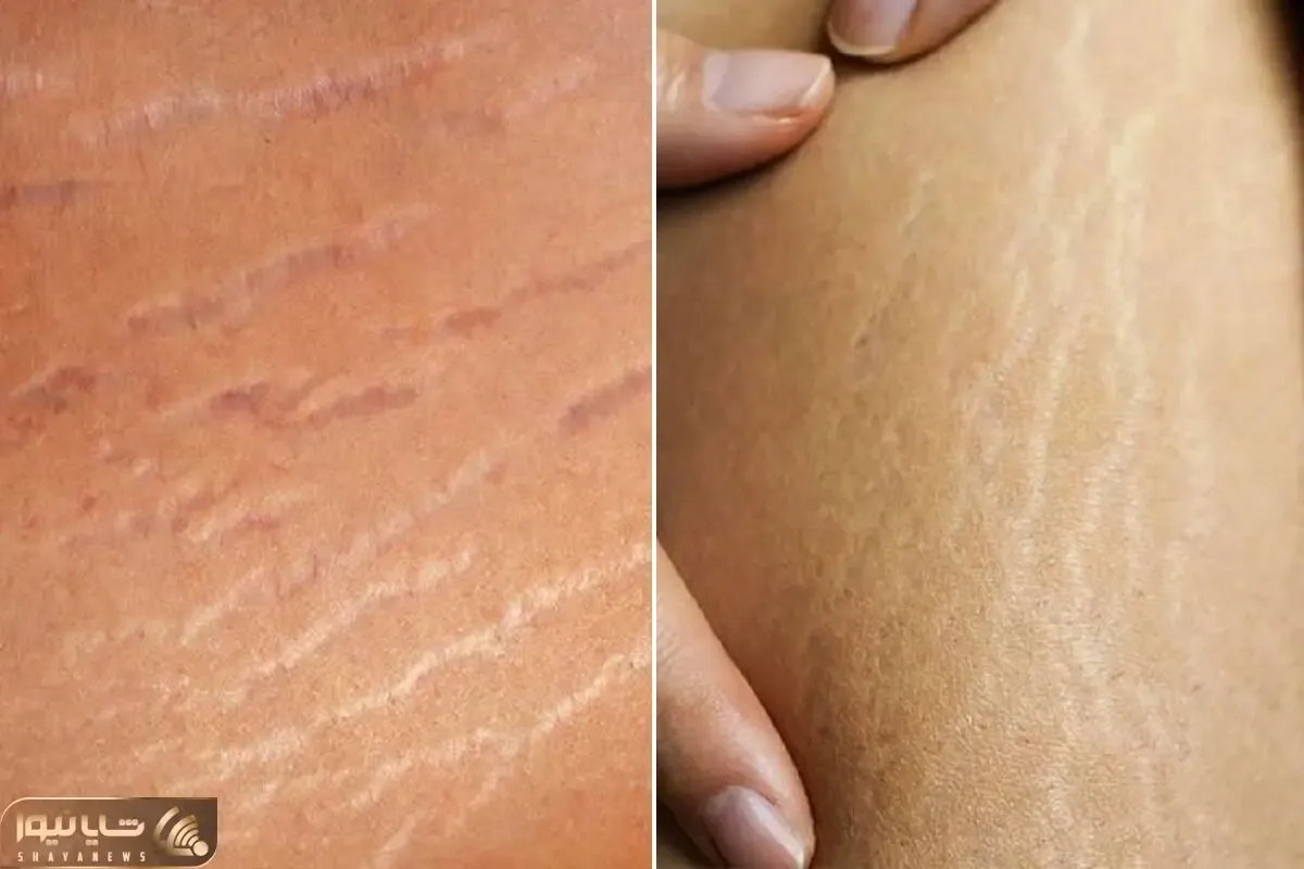 چطور بدون هزینه ترک‌ های پوستی را از بین ببریم؟ این راز را متخصصان زیبایی نمیگویند