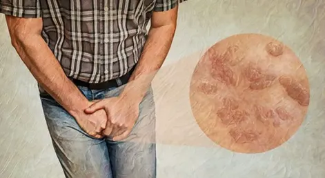 چگونه به بیماری پوستی تناسلی دچار نشویم؟