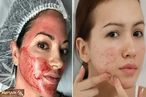 محبوب ترین روش های ازبین بردن جای جوش؛ فرورفتگی و چال نشدن پوست به شکل دائمی