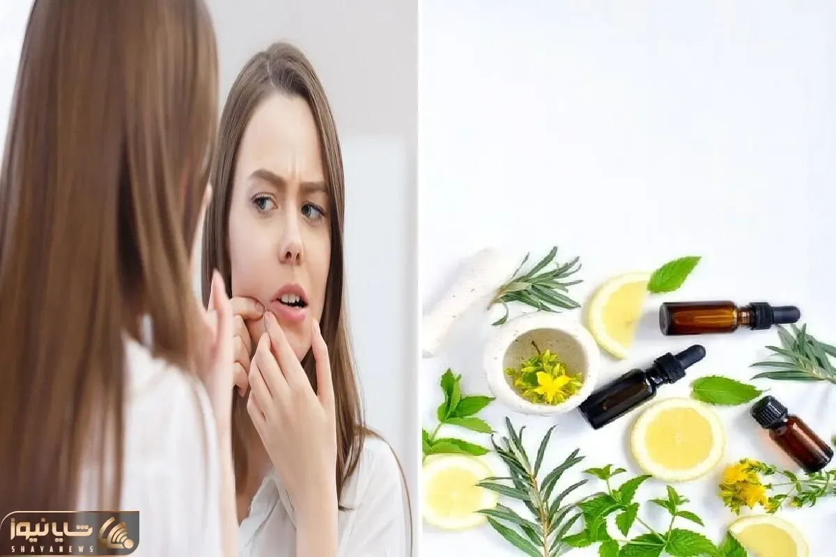گیاهانی که برای از بین بردن جای جوش خوب هستن / چاره ی کار تو دله طبیعته بیخیال لیزر