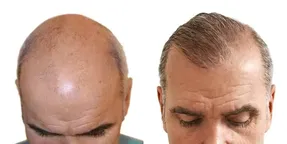 همه چیز درباره کاشت مو؛ از عوارض تا معایب