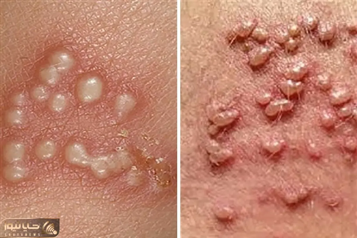 بهترین پزشکهای تهران برای درمان زگیل تناسلی؛ تفاوت و تشخیص جوش، تبخال و HPV