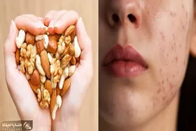 از بین بردن جوش های مجلسی تو عید / تو این ایام با پرخوری و خوردن آجیل جوش میزنی بیا