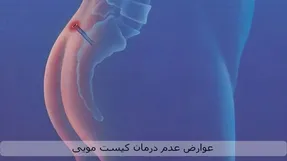 کیست مویی چیست؟ درمان کیست مویی با جراحی یا لیزر؟
