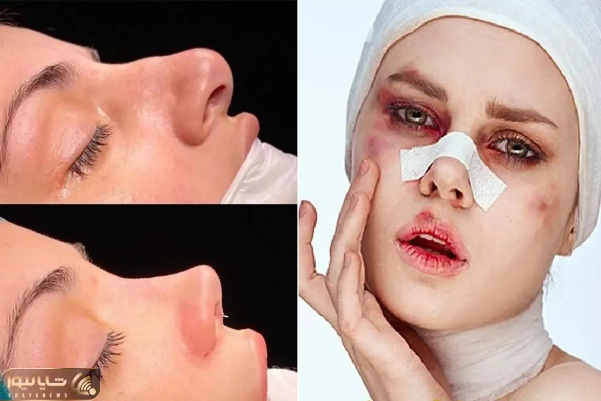 7 توصیه قبل و بعد عمل بینی / مبارکه خوشگل میشی اما بدون رعایت این نکات نتیجه عکسه