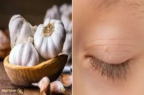 از بین بردن اسکین تگ همان منگوله پوستی ؛ بدون هزینه برای لیزر با مواد طبیعی و در خانه