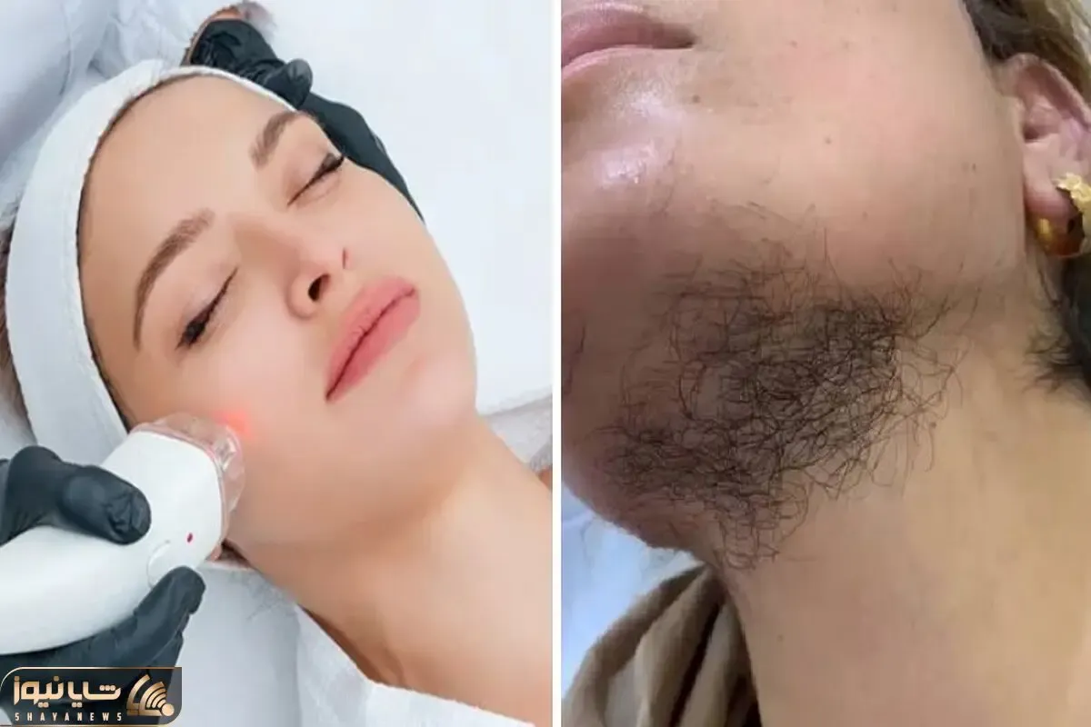 میخوای موی صورتتو لیزر کنی ولی نمیدونی محو میشه یا بیشتر؟ راهنمای تشخیص پشمالو نشدن
