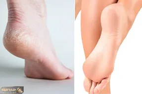 از ترک کف پاهات کلافه شدی؟ / بیا تا بهت بگم راهای جلوگیری و درمان خونگی و راحتش چیه