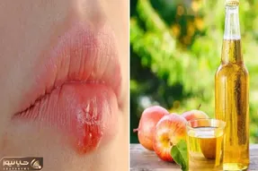 از بین بردن تبخال در کمترین زمان و تو خونه با استفاده از این ژل؛ التهاب رو نابود کن