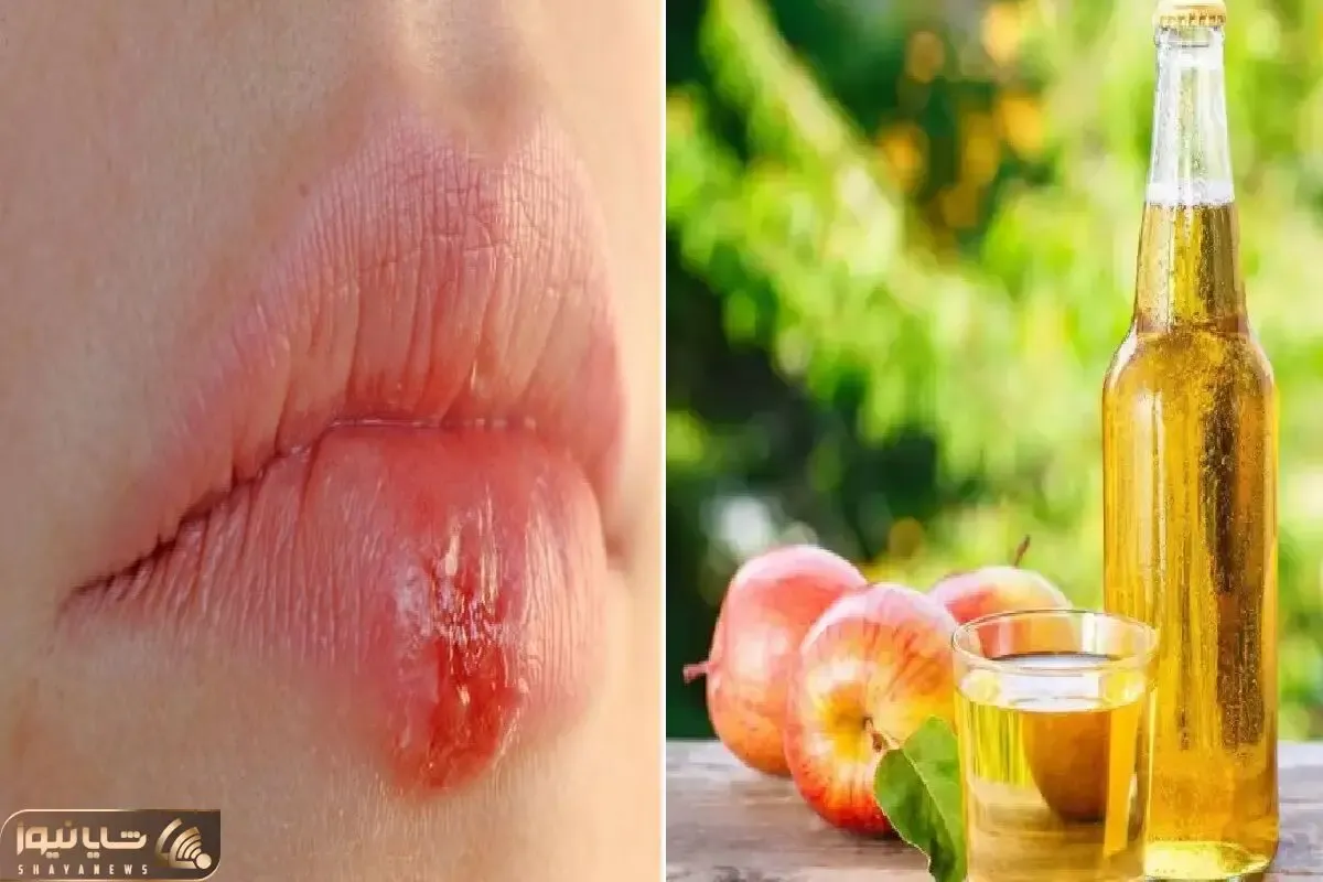 از بین بردن تبخال در کمترین زمان و تو خونه با استفاده از این ژل؛ التهاب رو نابود کن