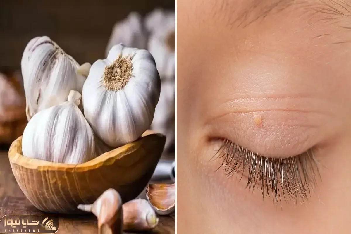 از بین بردن منگوله های پوستی با روش خونگی / لیزر نکن با این ماده دو روزه نابود میشن