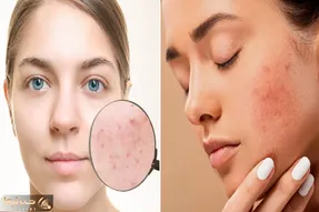 جوش چرکی زدی درد میکنه اما هنوز منتظری برسه خالیش کنی/ اینطوری کن میگی آخیش جاشم میره