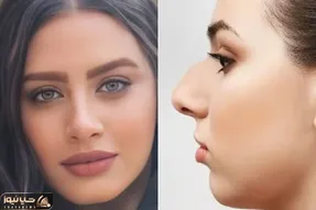 مدل های زیبای بینی گوشتی بعد از عمل؛ با اینا میتونی ببینی دماغتو عمل کنی چه شکلی میشی