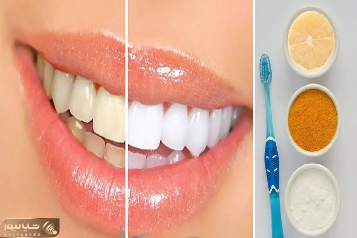 سفید کردن دندون ها با مواد طبیعی و در عرض 20 دقیقه؛ بلیچینگ بی خطر و خونگی