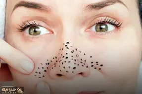از بین بردن دون دون های سیاه بینی؛ امتحان نمیکردمش باورم نمیشد تخم مرغ این کارو کنه