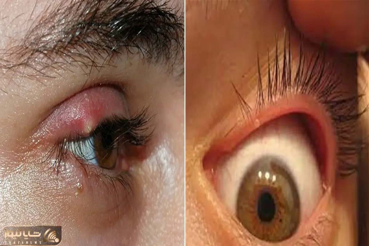 ترفند از بین بردن گل مژه در خانه و در عرض یک روز / بشمار سه خودتو خلاص کن