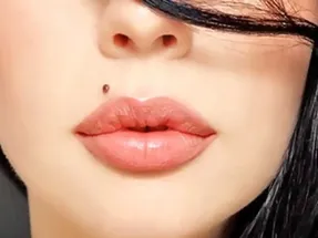 علت خال قرمز روی پوست چیست و آیا این خال خطرناکه؟