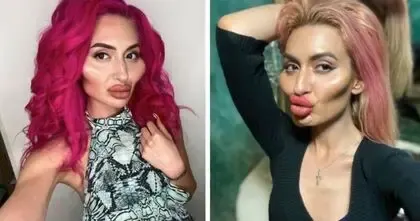 (عکس) آناستازیا پوکرشچوک زنی با بزرگترین گونه و جراحی های زیبایی عجیب!