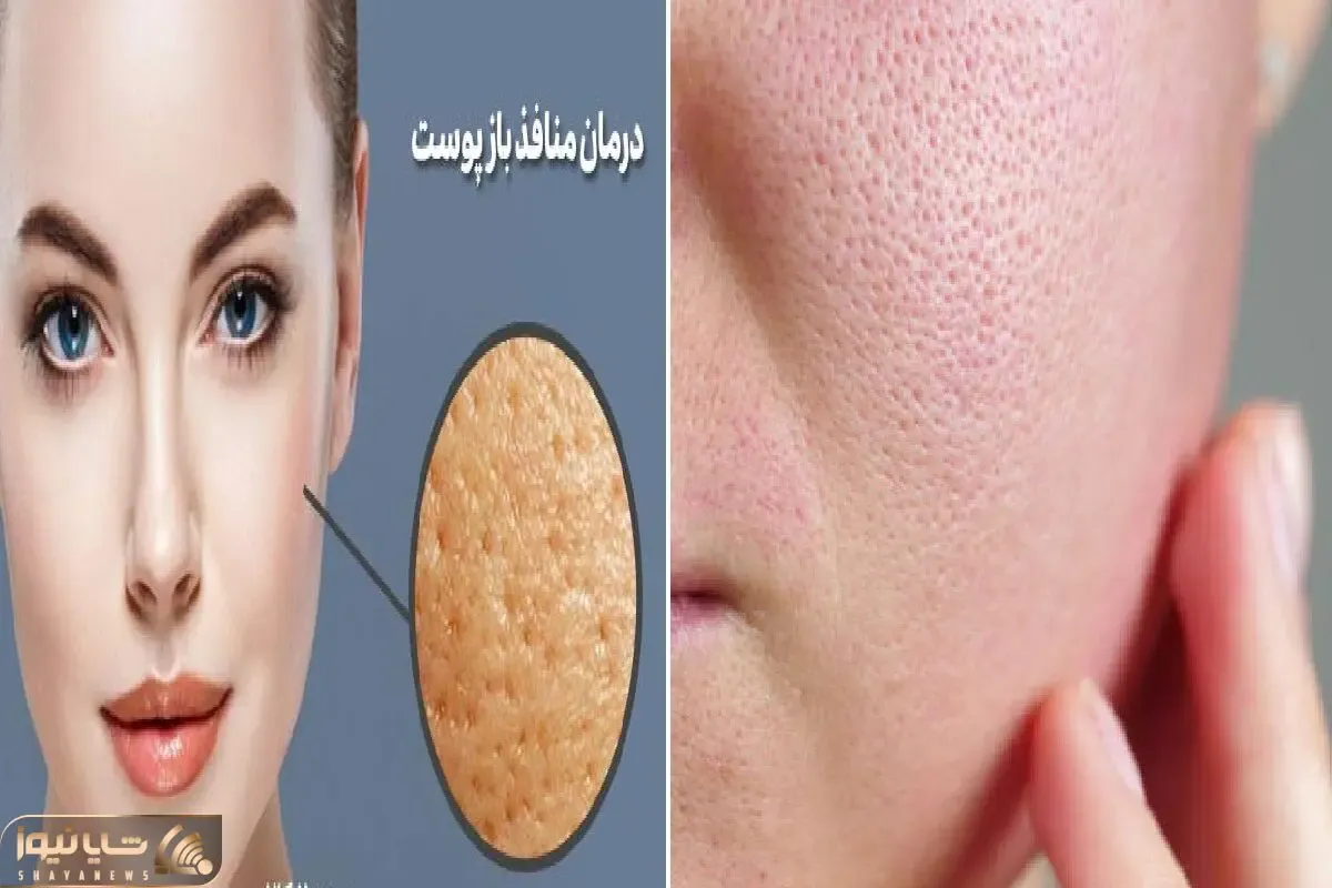 چطور منافذ باز پوست رو ببندیم؟ / یادت باشه پوست سالم نباید مثل توت فرنگی دون دون باشه