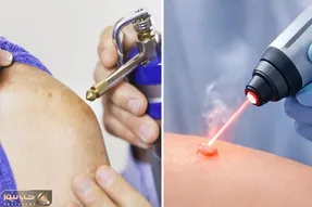 کرایو بهتره یا لیزر؟ از بین رفتن همیشه زگیل تناسلی با انتخاب بهترین روش بسته به اندازه