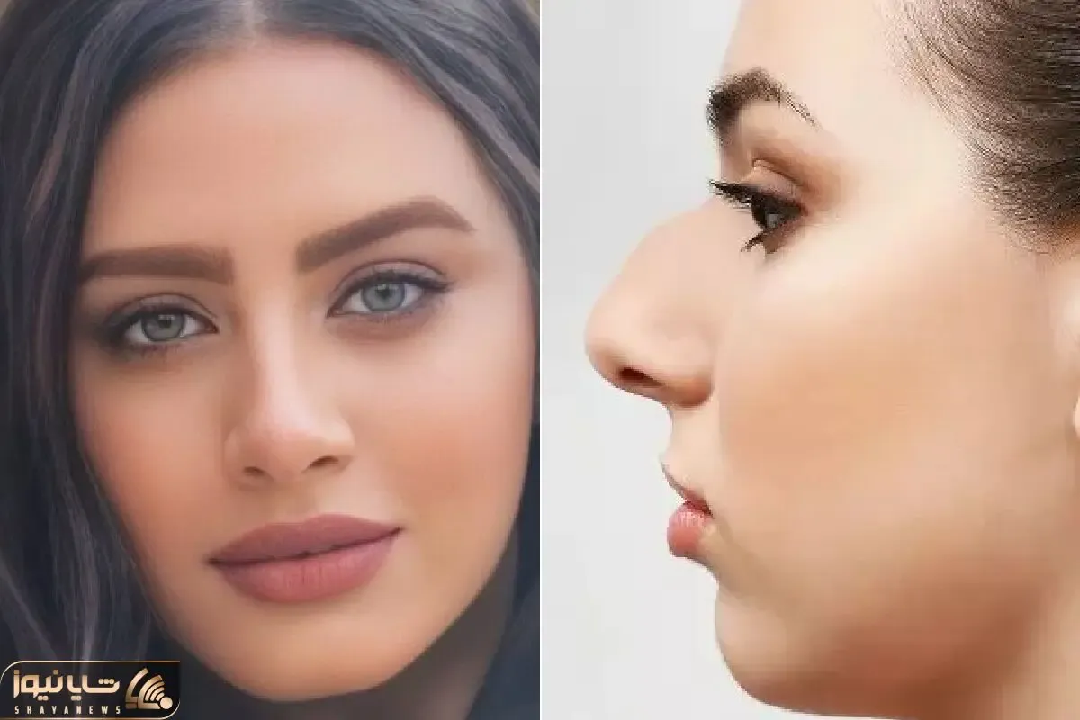 مدل های زیبای بینی گوشتی بعد از عمل؛ با اینا میتونی ببینی دماغتو عمل کنی چه شکلی میشی