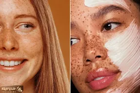 از بین بردن لک های قهوه ای صورت در خانه / ماهم پر از لکه ست ولی هنوزم خوشگله مثه تو