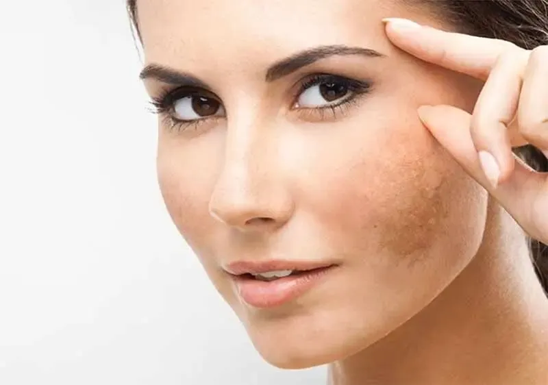 چطور لکه‌های پوستی‌رو از بین ببریم و از شرشون خلاص شویم؟